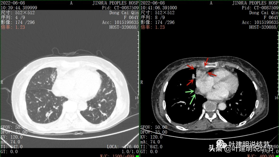 这位老乡，乏力来查，查出这么大个的纵隔肿瘤！会是什么呢？