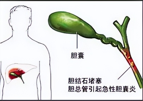 肝火上逆耳鸣口苦中成药,耳鸣口苦肝火旺吃三种中成药