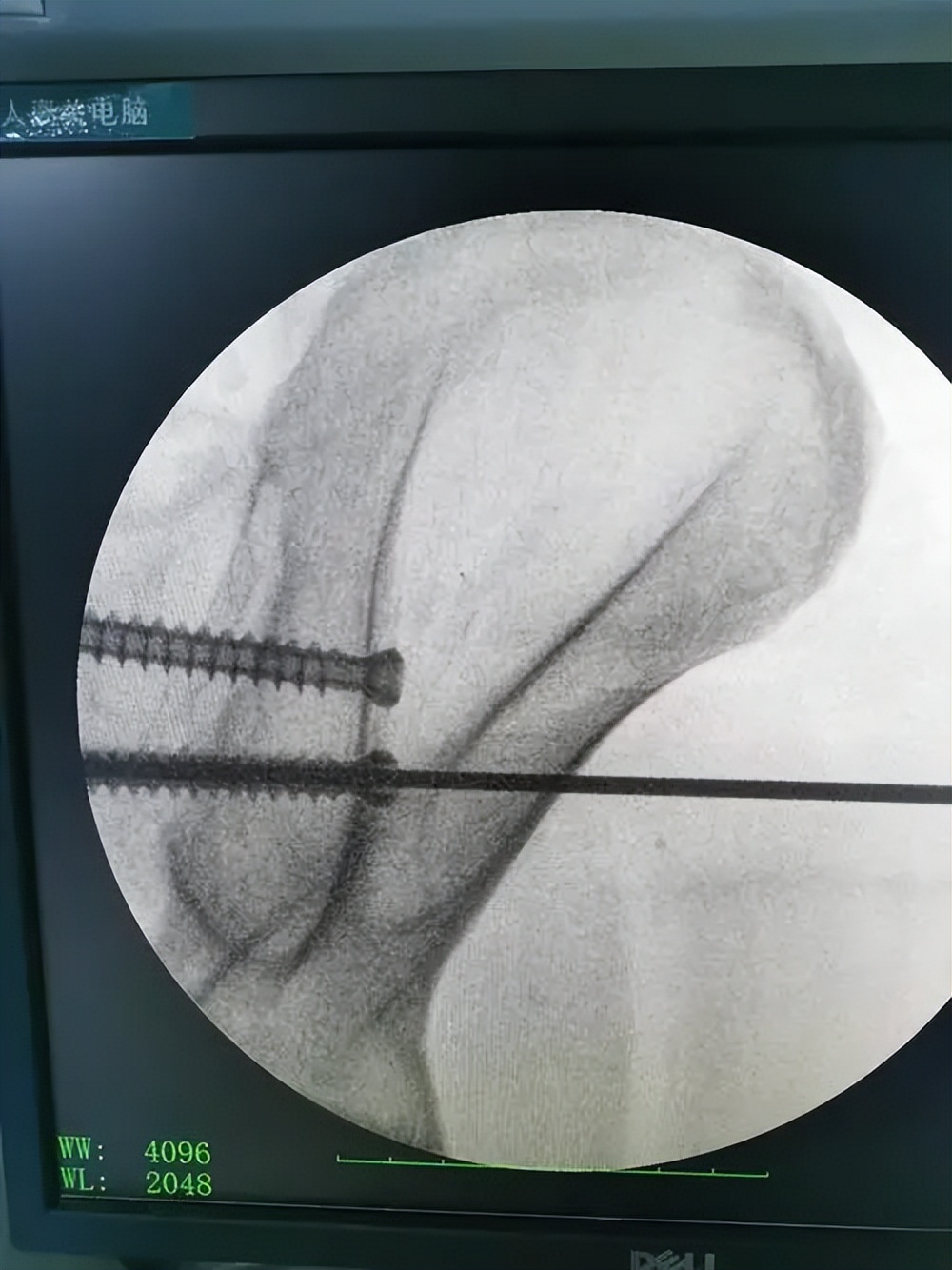 骨盆后环损伤后，新型螺钉的不同内固方法各有何优势？哪种方法好