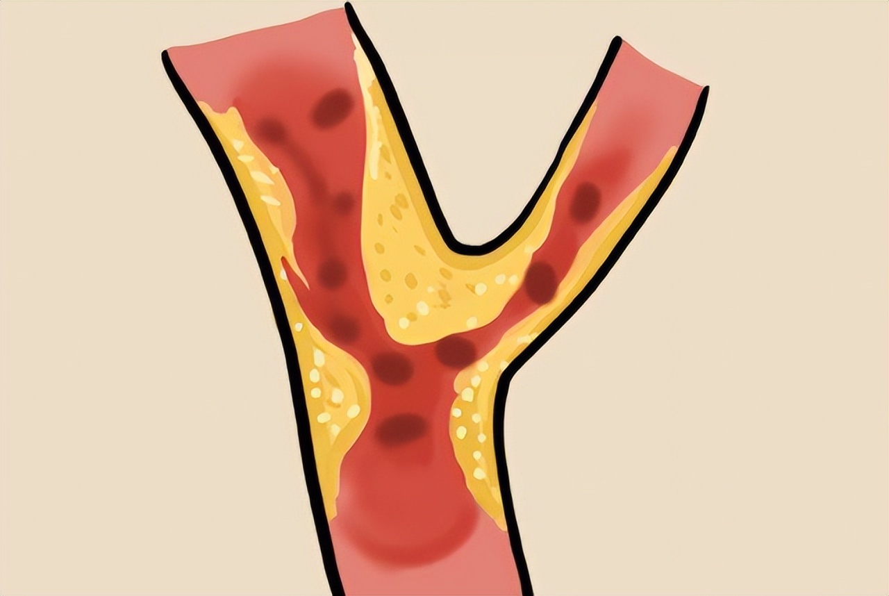 体检颈动脉有斑块但血流未见异常,体检有颈动脉斑块怎么治疗啊