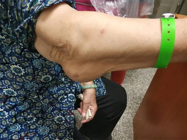 身上长出“疙瘩”一定是痛风？可能是类风湿结节