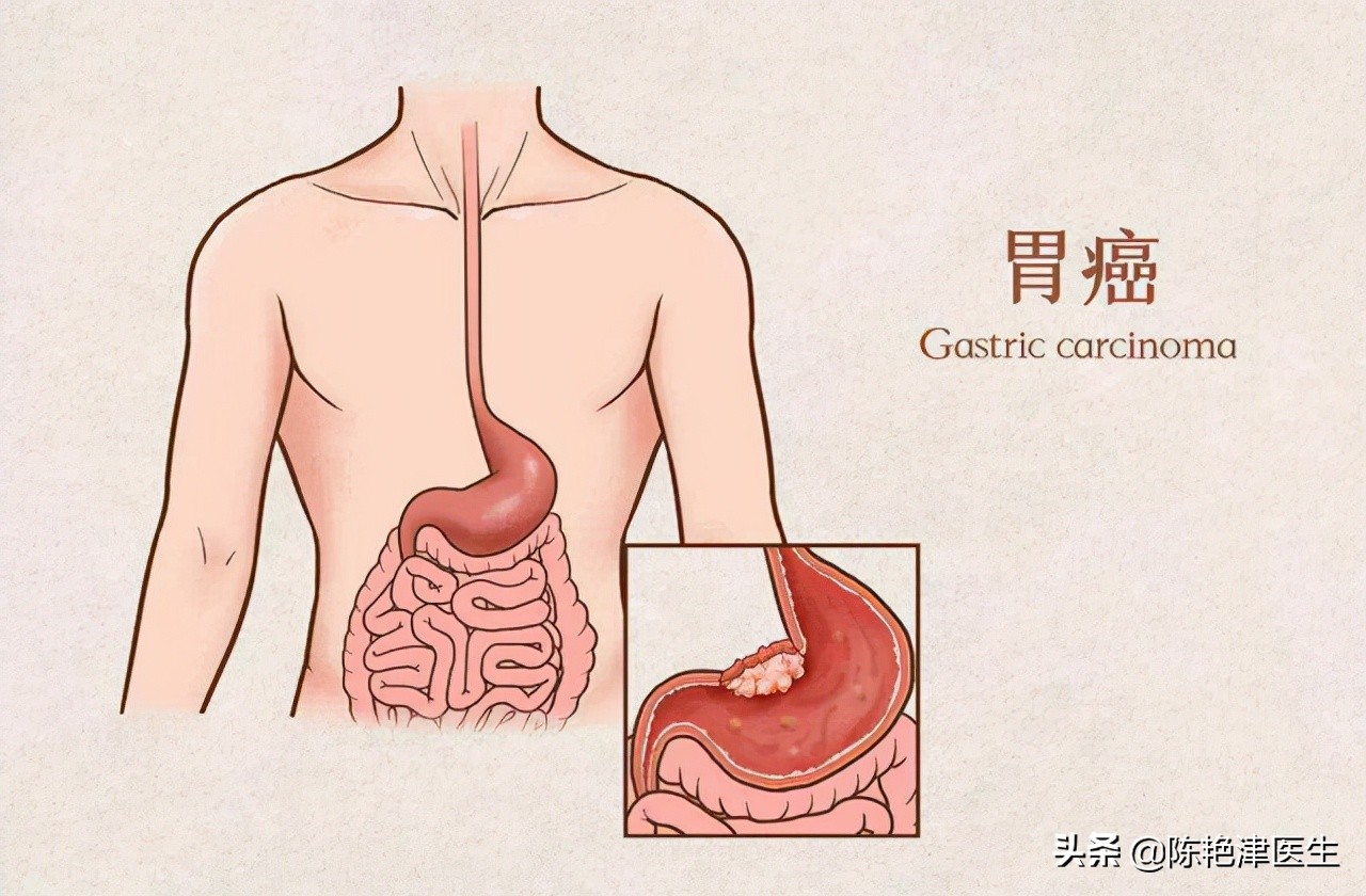 胃癌最大的祸根是幽门螺杆菌，想要彻底杀菌，记住3个办法