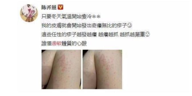 过敏性疾病自愈的秘诀,世界过敏日谈过敏