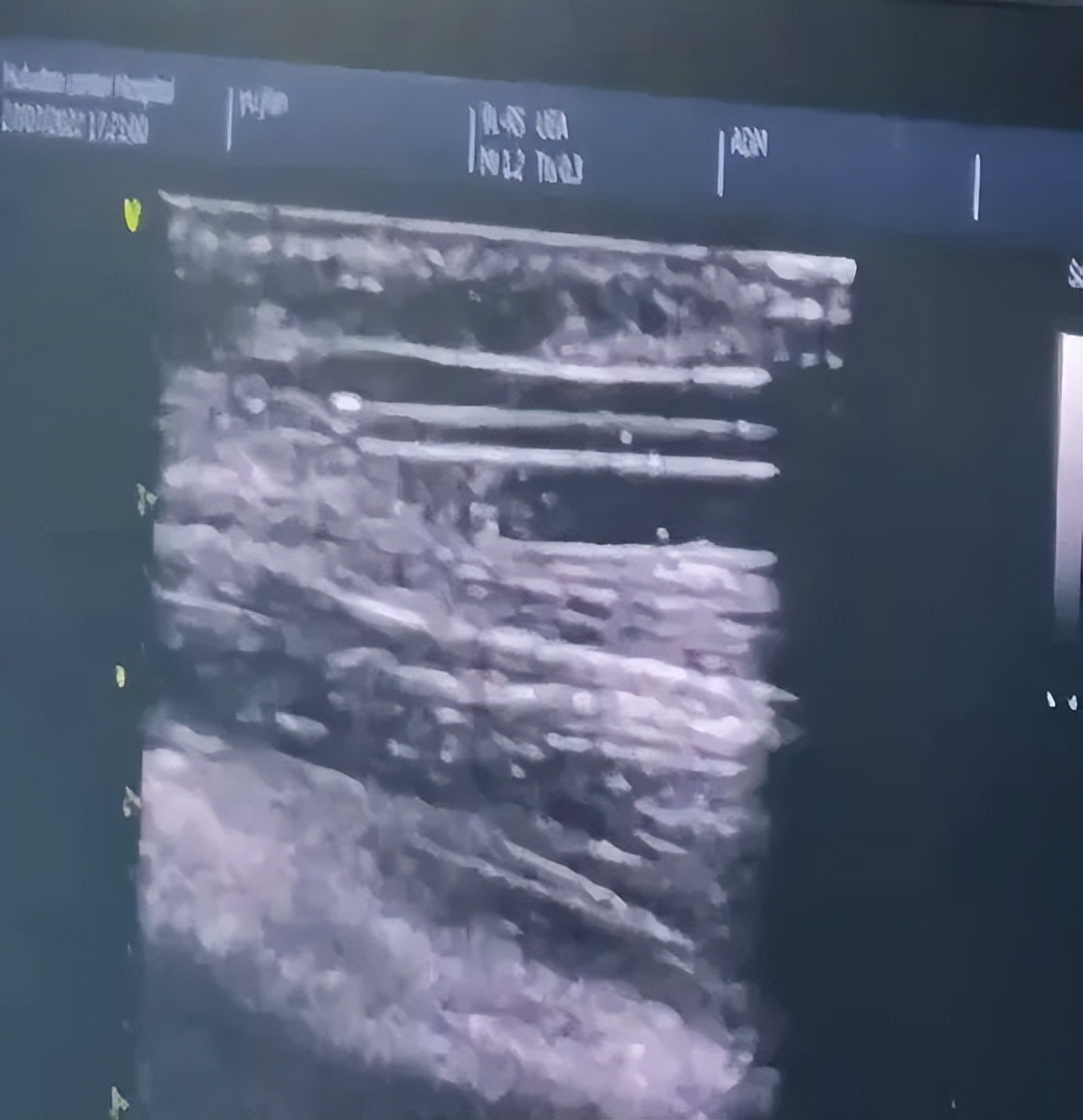 医院开展首例自体动静脉内瘘手术,自体动静脉内瘘超声评估