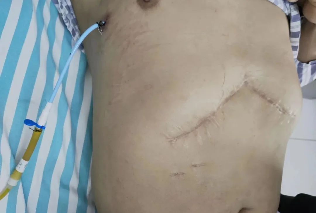 肝内胆管结石微创取石恢复快吗,一男子从胆囊取出几百个结石