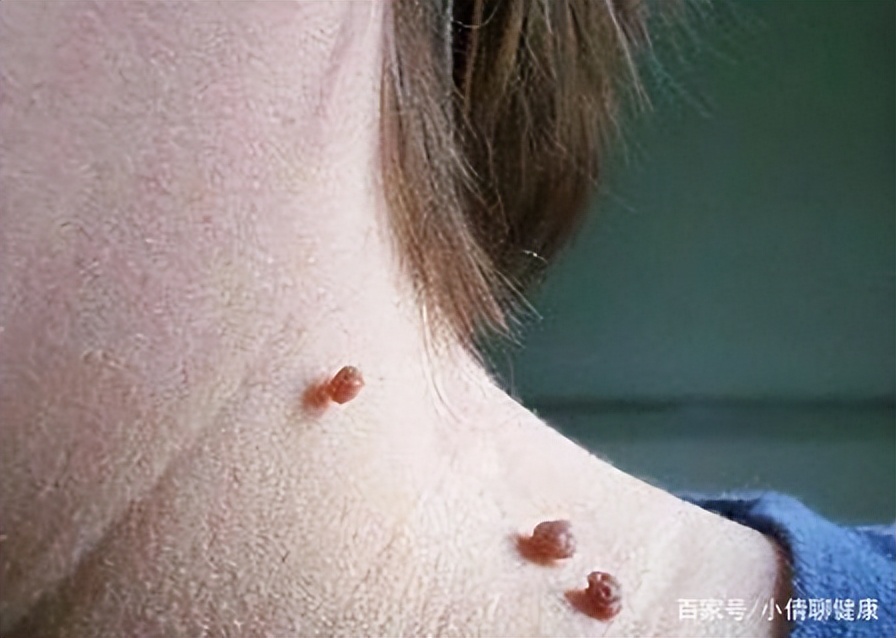 脖子腋下的小肉粒是什么,脖子上肉粒可以自己揪掉么