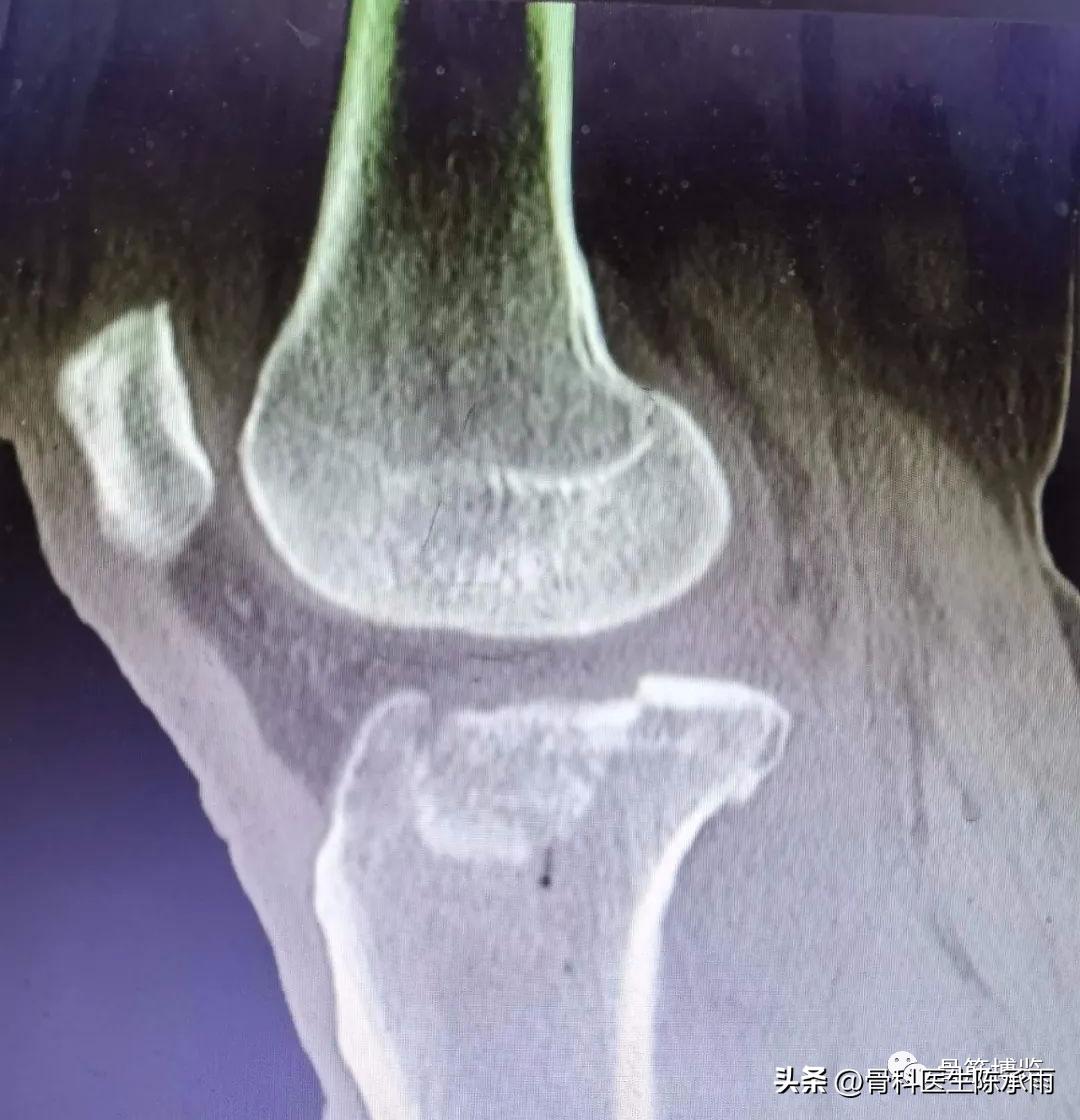膝关节胫骨平台骨折,最近胫骨平台骨折视频