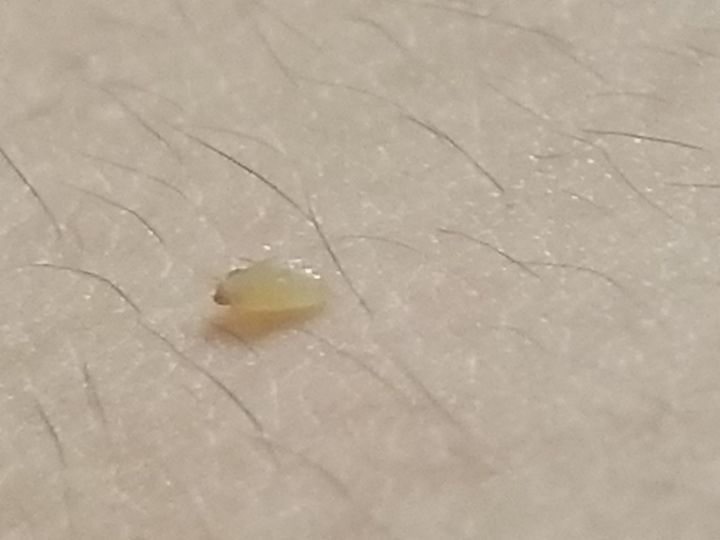 20年的黑头有多大,世界上最长的黑头到底有多长