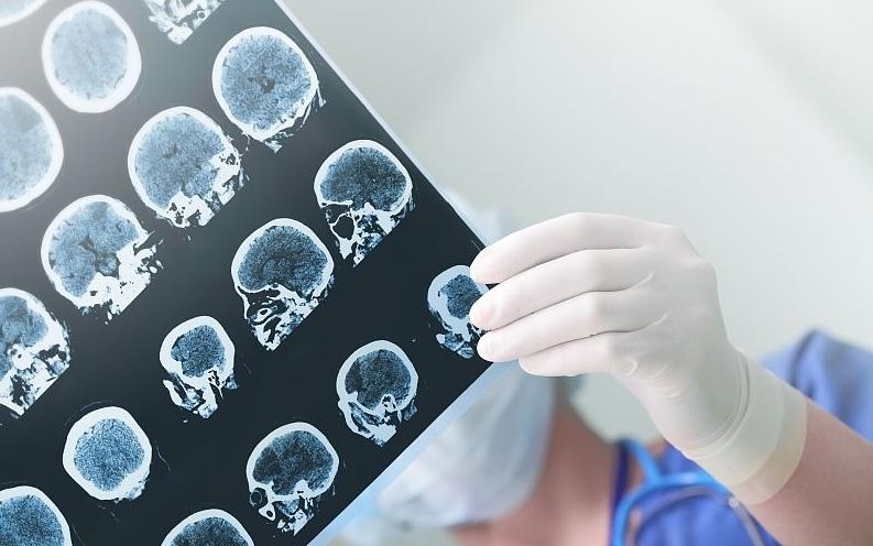 左颞蛛网膜囊肿引起癫痫,蛛网膜囊肿引起癫痫的症状