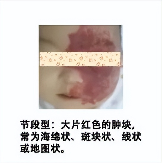 小孩胎记长肉瘤,小孩身上一块黑色胎记越长越大