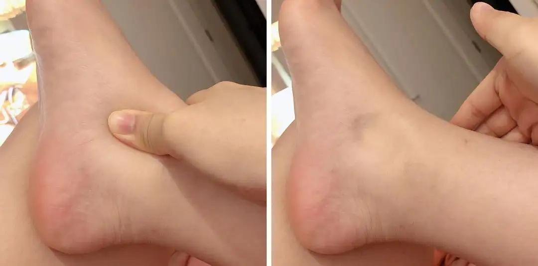 肺癌肾病综合症,32岁女性双下肢水肿