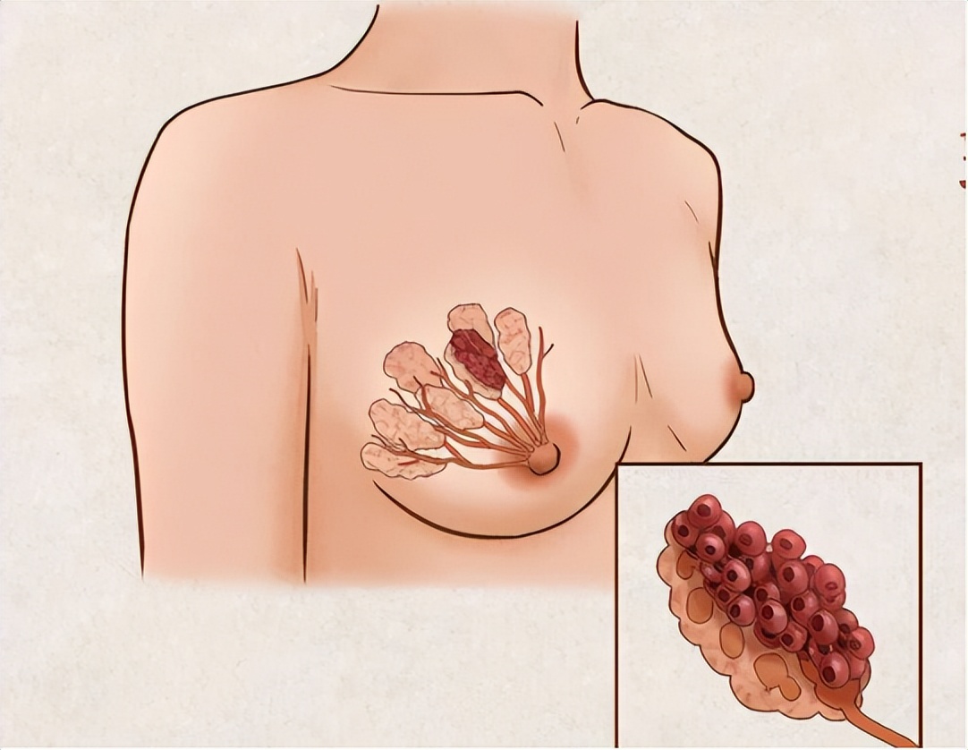 异时性双侧原发性乳腺癌10年,双侧原发性乳腺癌需要化疗吗