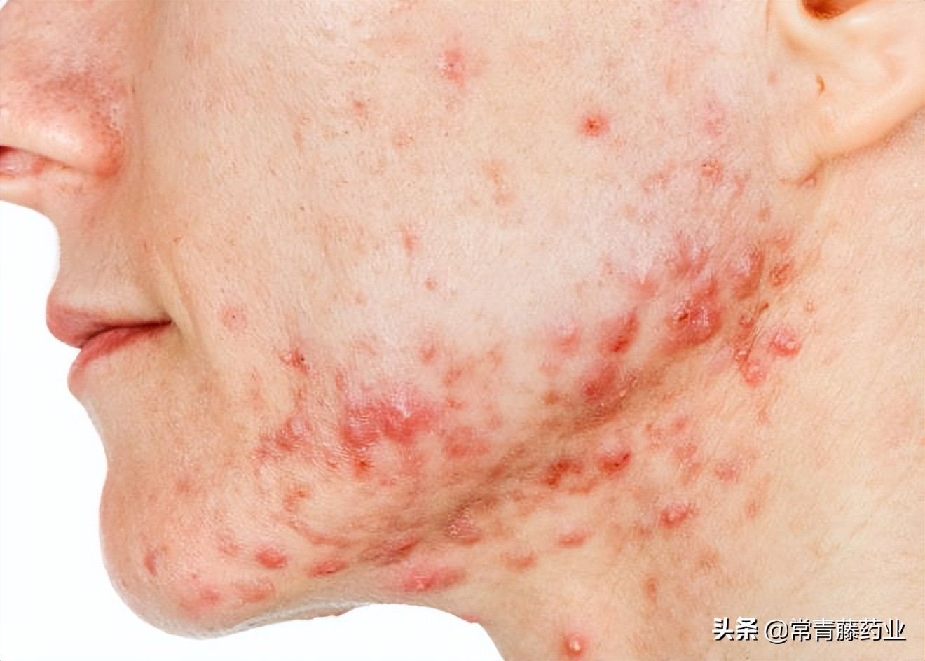 脸颊肿了一个包硬硬的怎么处理,脸颊长个包硬硬的凸起