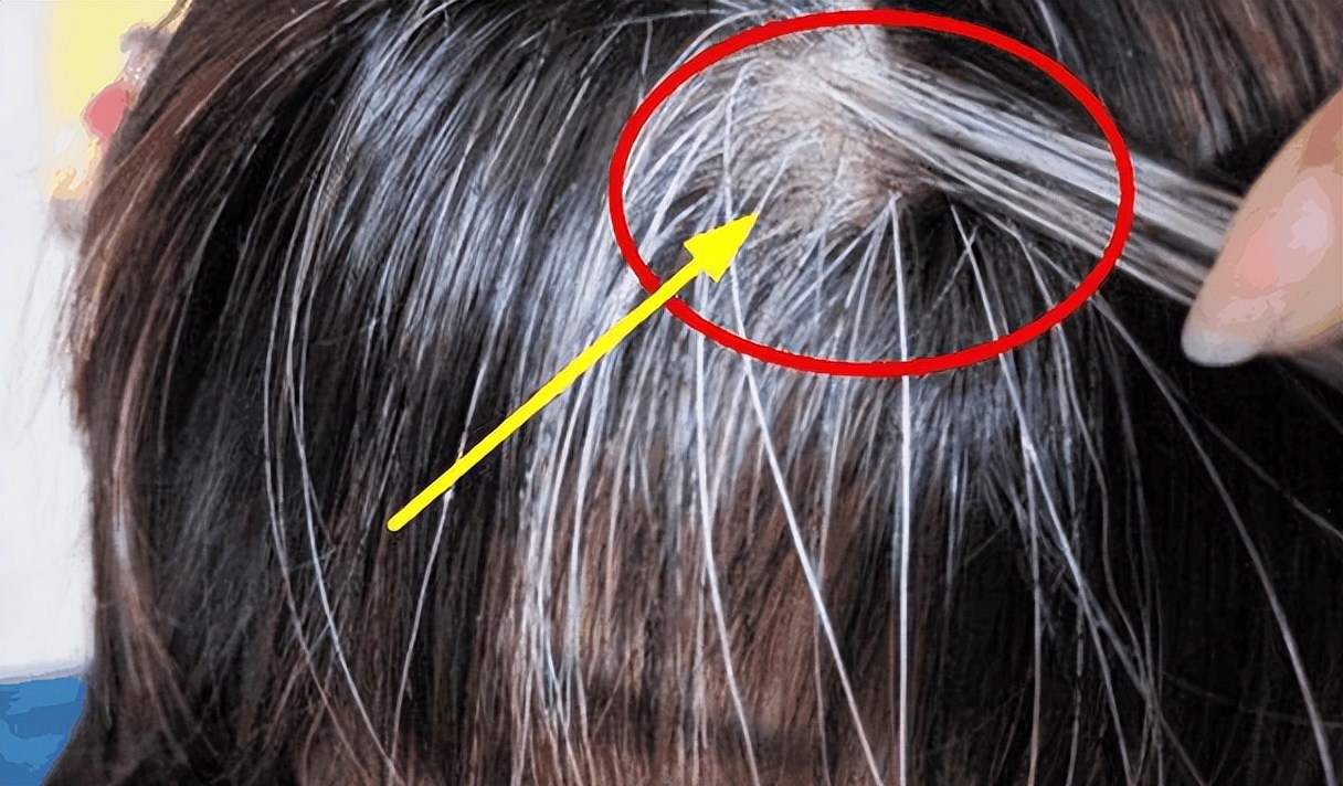 头发一夜变白的主要原因是什么,头发变白一绺怎么回事