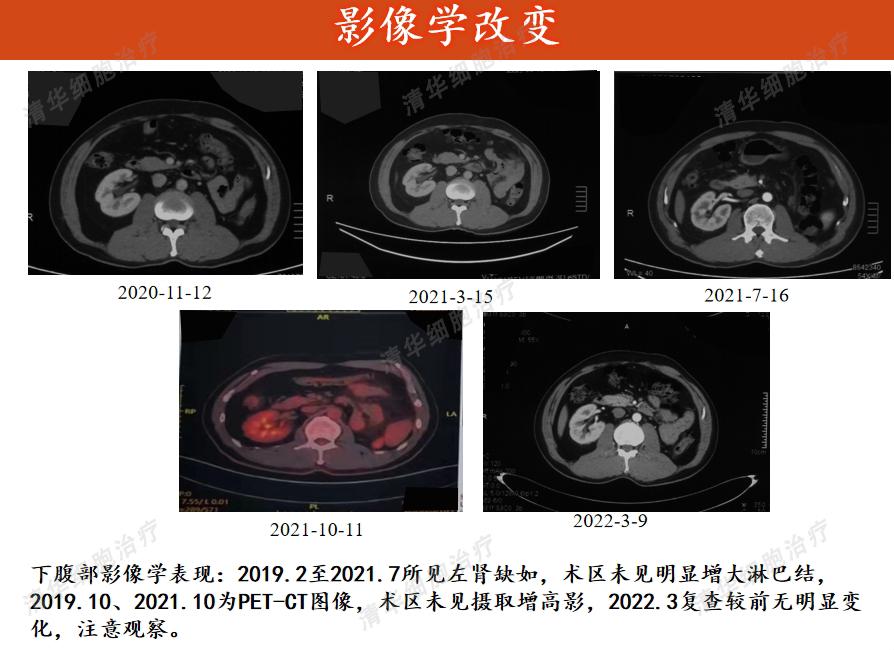 患癌20年经历2次转移最终抗癌成功,肾癌10年后发生转移