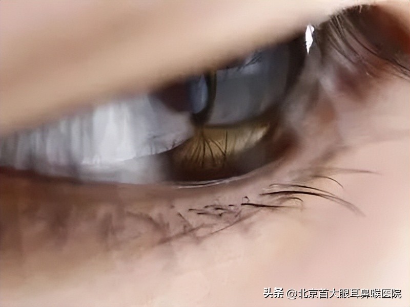 北京干眼症的最佳治疗方法,北京眼科医院治疗黄斑病变