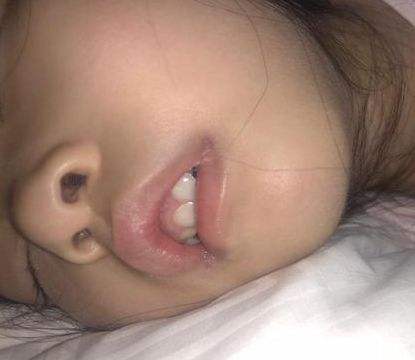 扁桃体腺样体肥大：手术治标中医治本，讲4个中医常用方法，收好