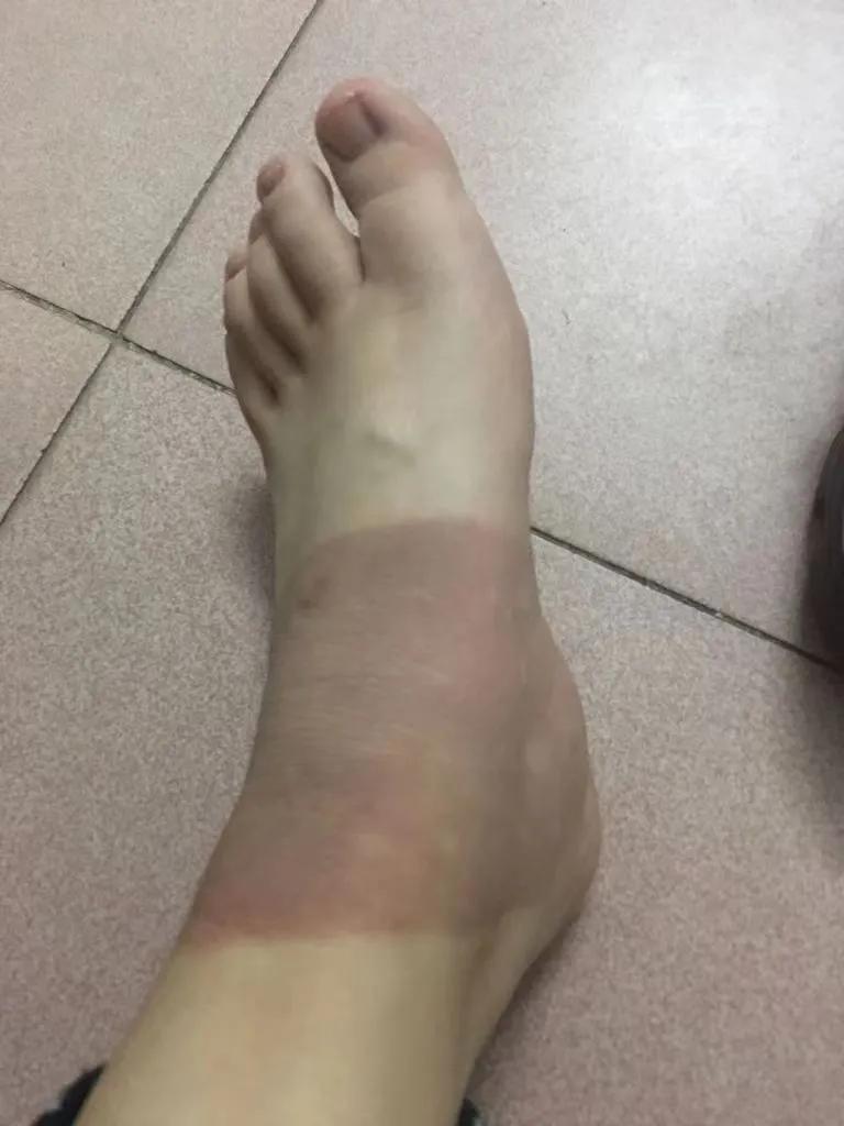 女生教你脚踝扭伤处理方法,脚踝扭伤一年后还疼怎么处理