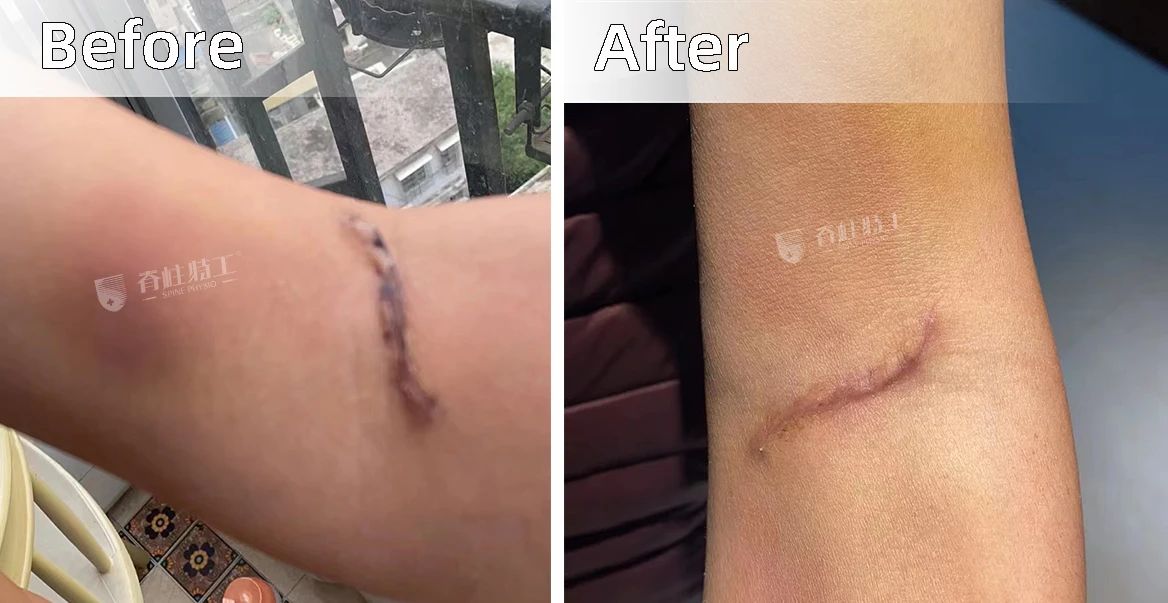 手肘骨折术后肿胀多久会完全消除,手肘骨折恢复后手僵硬康复治疗