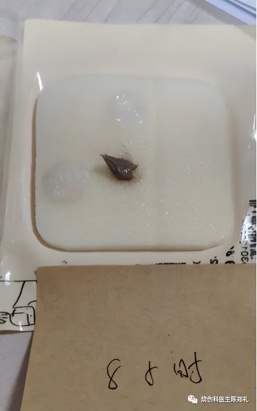 慢性创面患者的敷料运用及选择,创面换药敷料的选择