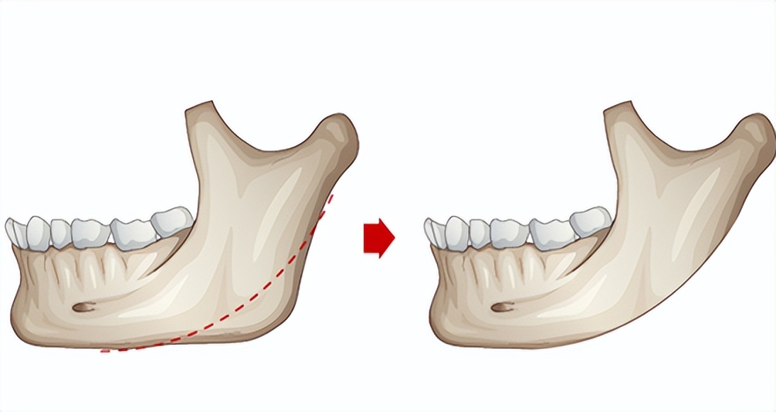 上海九院韦敏轮廓做得好吗,九院韦敏下颌角截骨案