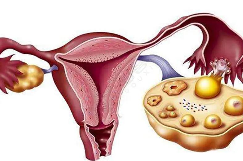 多囊导致不孕怎么调？中医：辩证论治，因势利导！