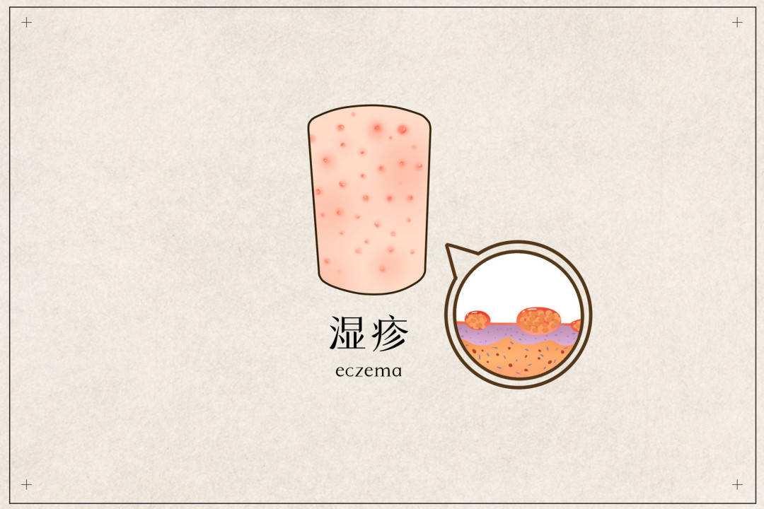 一脱秋裤就皮屑满天飞,一脱秋裤皮屑满地飞怎么办