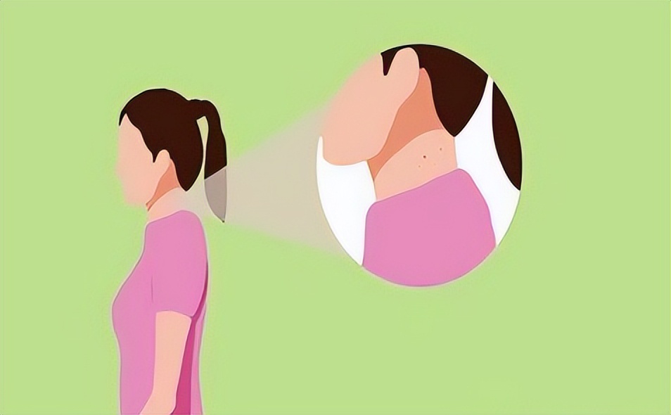 腋下的小肉粒可以揪掉吗,脖子上长的小肉粒可以揪掉吗