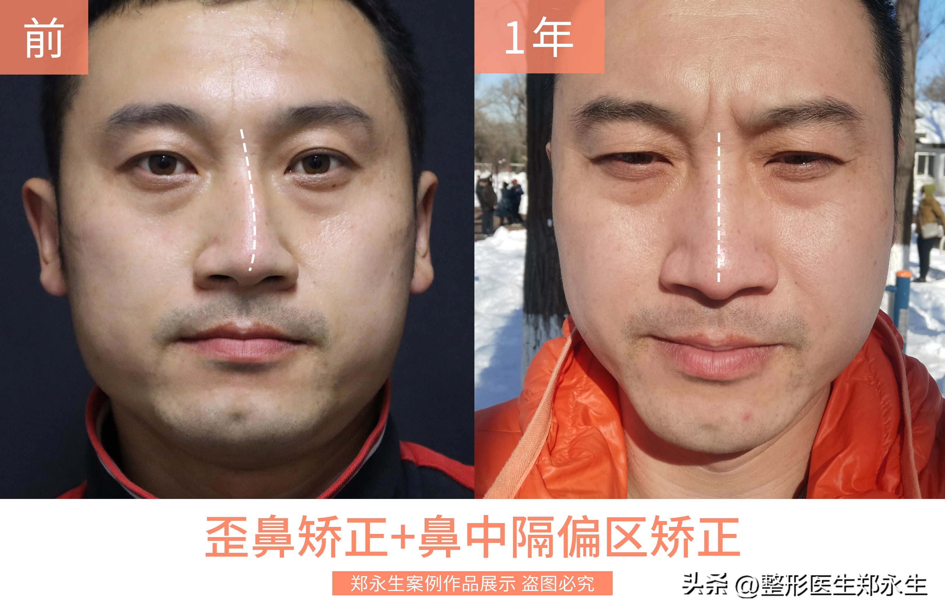 鼻中隔偏曲矫正三大误解：自我矫正、徒手正骨和吃药改善