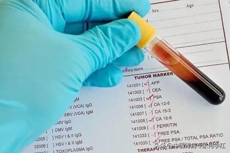 肾功能检查肌酐高说明了什么,肌酐高不能吃什么