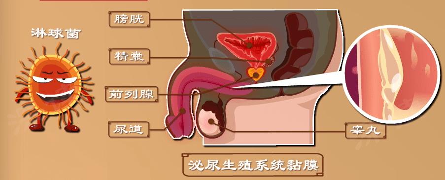 湿疣梅毒淋病怎么引起的,淋病梅毒湿疣症状