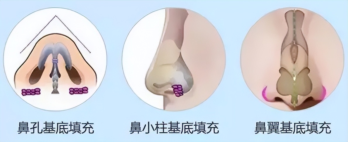 小拉皮加填充法令纹做好休息多久,法令纹严重是做拉皮还是做填充好