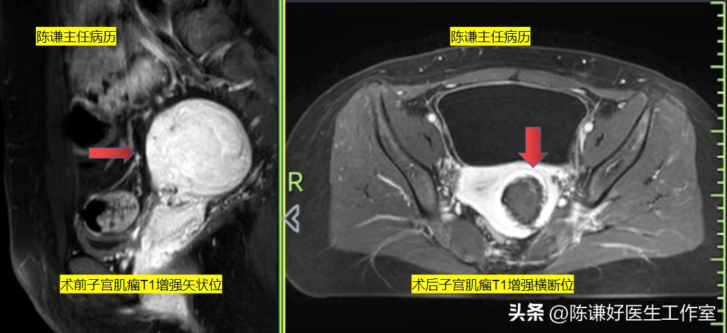 未婚未育子宫肌瘤该如何处理？