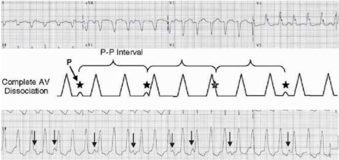 心电图上表现为宽qrs波,心电图中qrs是代表心动过速吗