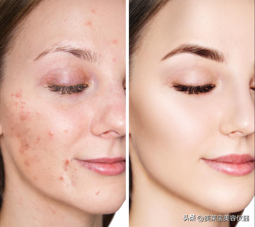 祛痘仪真的能祛痘吗,祛痘仪怎么样好用吗