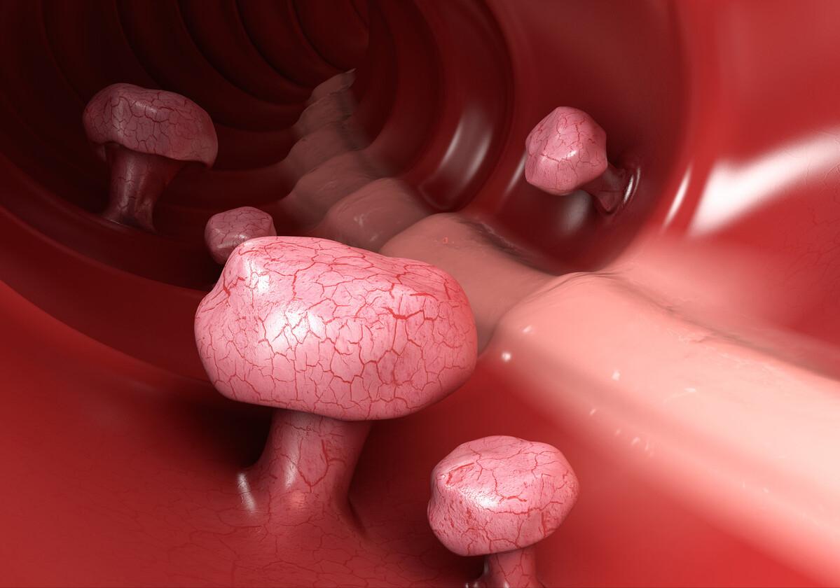 警惕这四种肉可能会引发癌症,14岁胳膊肘有肉瘤会癌变吗