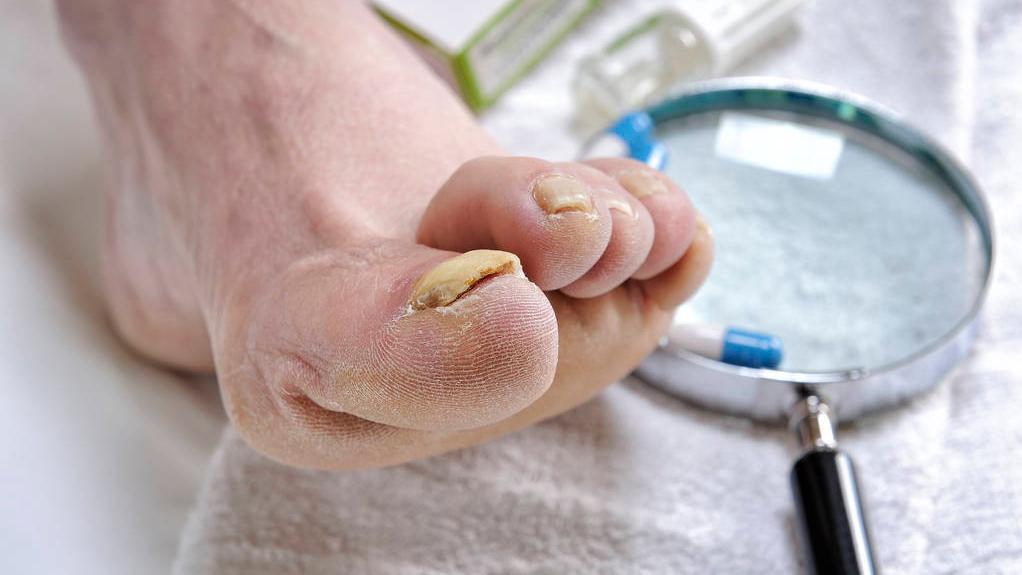 治疗灰指甲用什么中草药能根除,治疗灰指甲需要注意什么