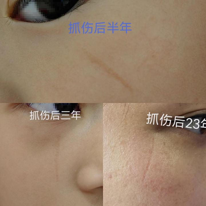 疤痕早期激光干预,疤痕激光治疗最佳方法