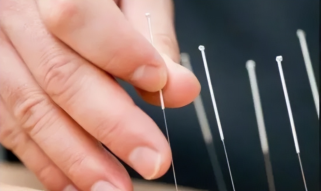 针灸治疗空调吹出的面瘫