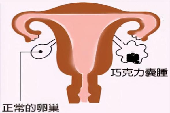 巧克力囊肿备孕中药调理能消掉吗,巧克力囊肿术后多久可以备孕