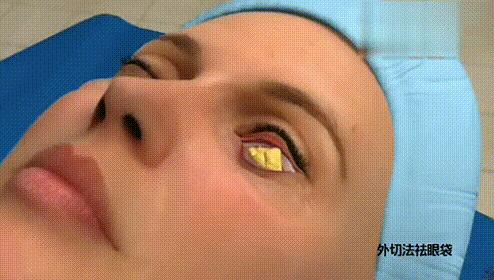 眼袋类型分不清,眼袋卧蚕傻傻分不清