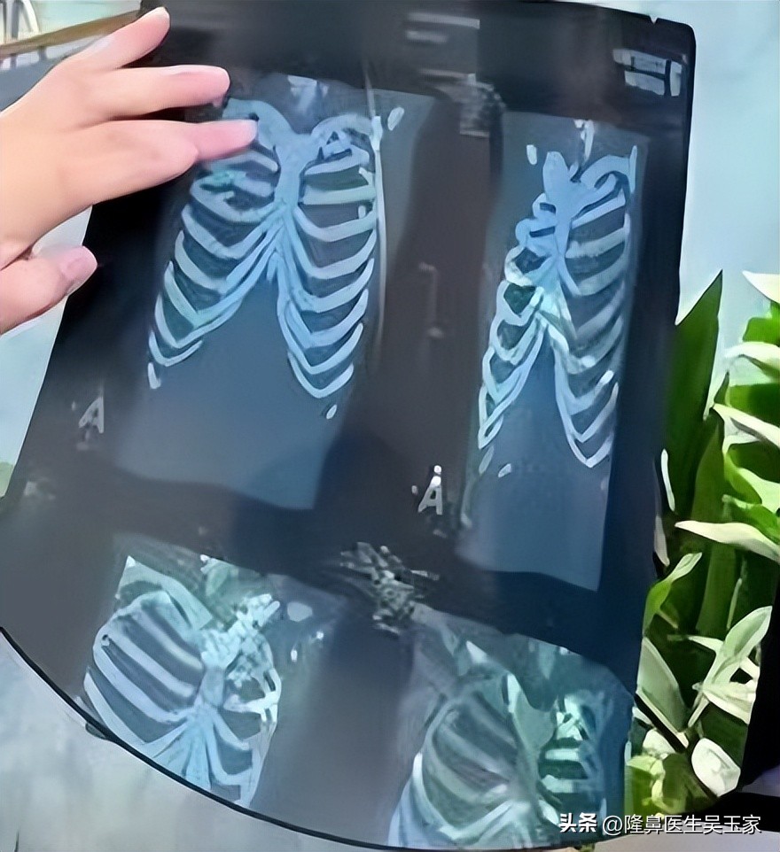 朝天鼻隆鼻1-7天恢复过程图,隆鼻修复鼻背过程经历真实