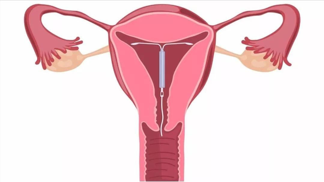 宫外孕都是有什么状况,宫外孕是什么原因造成的严重吗