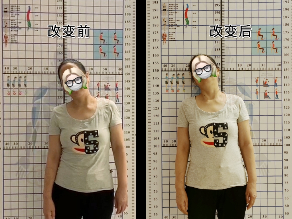 颈椎间盘突出压迫桡神经怎么恢复,颈椎间盘突出压迫手指麻怎么治疗