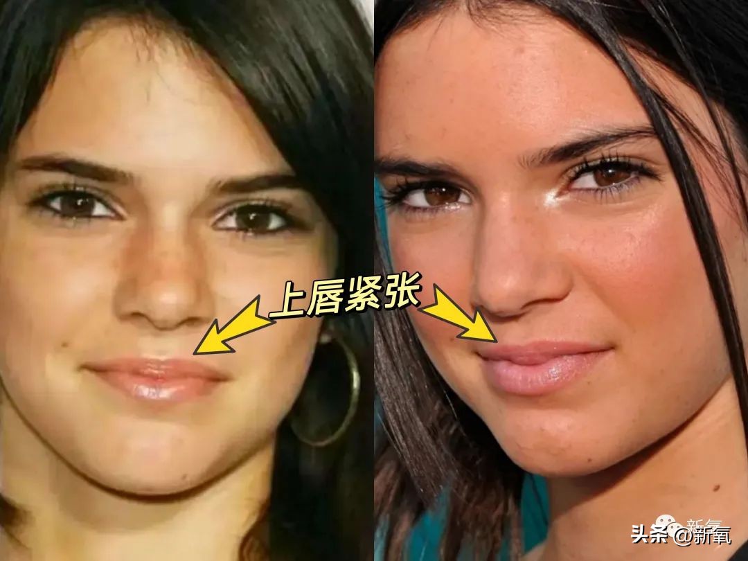 牙齿正畸和骨骼正畸的区别,牙齿正畸和眼轴增长有关系吗