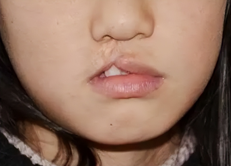 婴儿唇腭裂怎么护理,唇腭裂麻醉