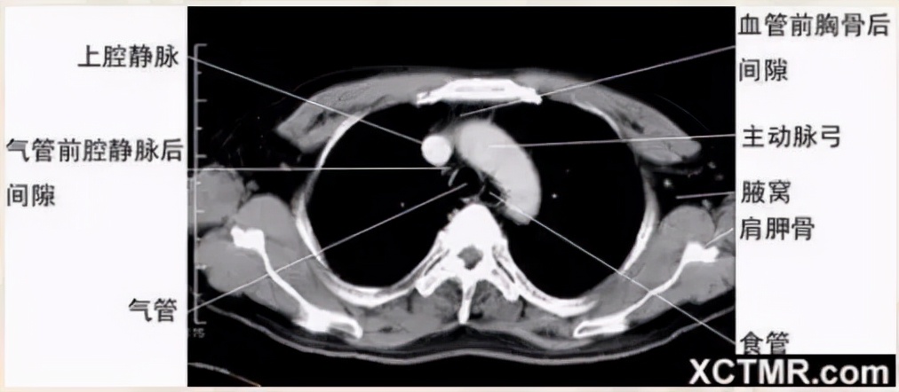 胸腹部盆腔ct主要检查什么,女性盆腔ct断层解剖结构图