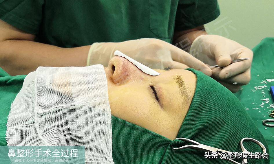 隆鼻手术全过程女生,隆鼻手术到底是怎么进行的