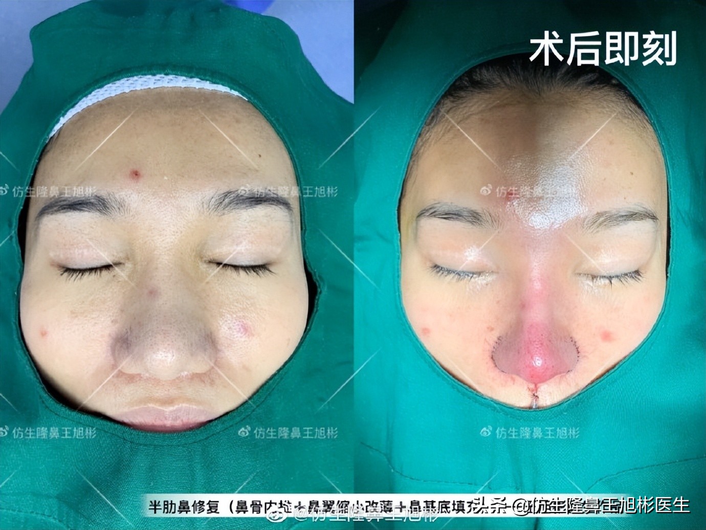 做一次鼻头缩小要多少钱好,可以只做鼻头缩鼻翼吗