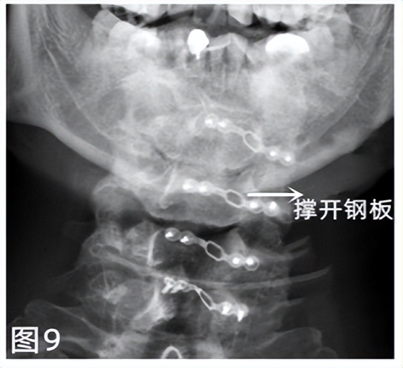 脊髓型颈椎病手术费用一览表,椎动脉型颈椎病手术风险多大